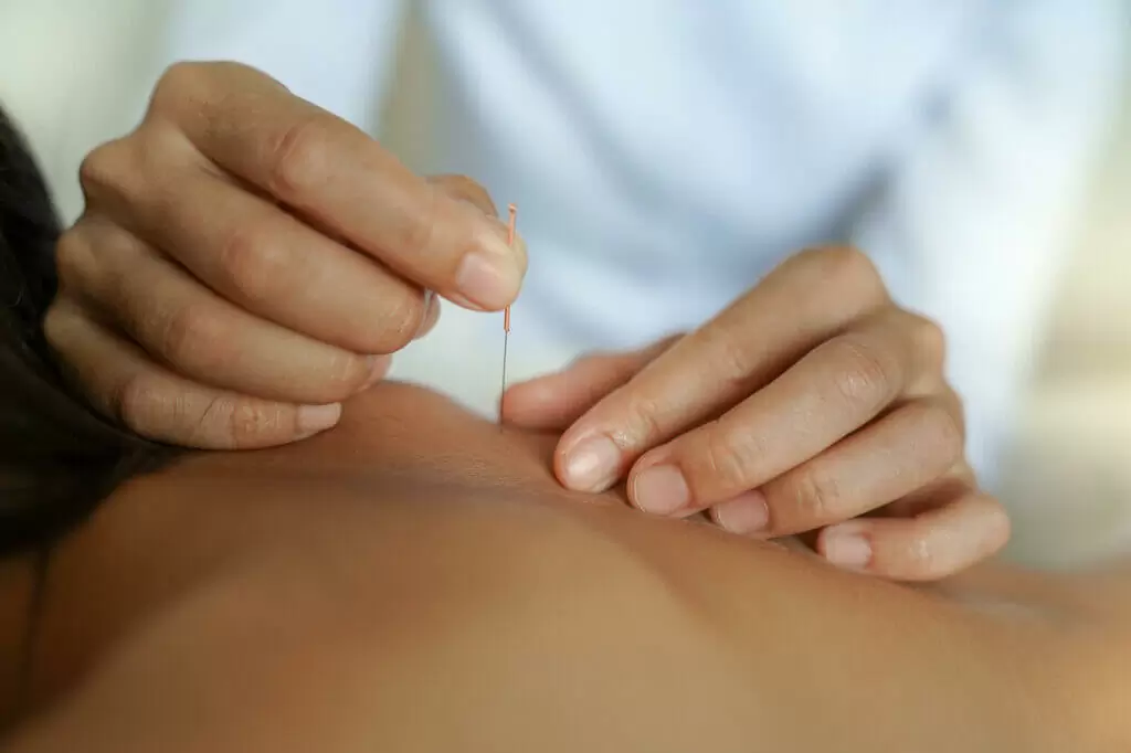 The Benefits of Dry Needling