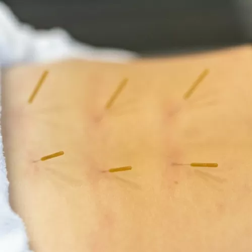 dry-needling-3-taylor-rehab-Mooresville-NC