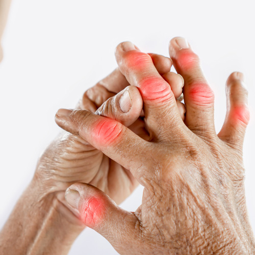 5 Ways to Manage Arthritis Pain — Without Surgery